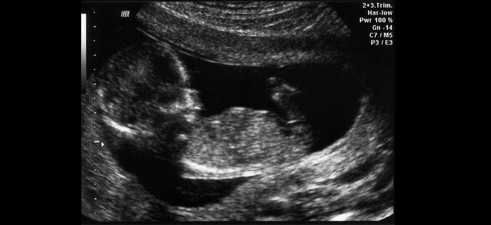 УЗИ на 14 неделе беременности - фото