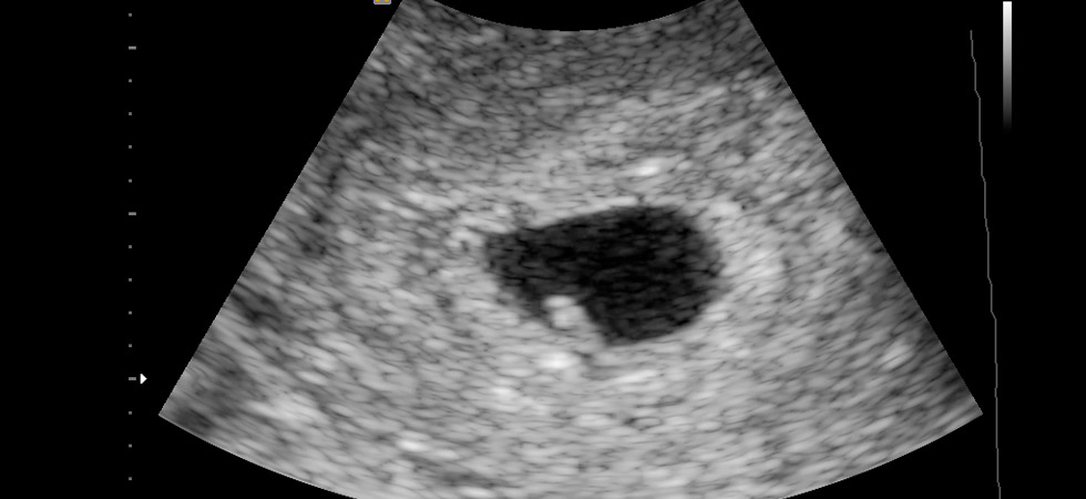 УЗИ на 5 неделе беременности - фото