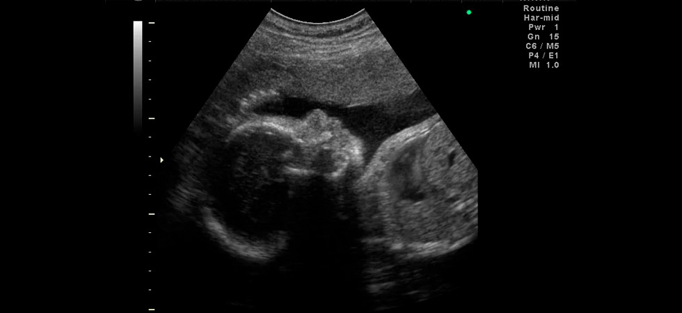 УЗИ на 25 неделе беременности - фото