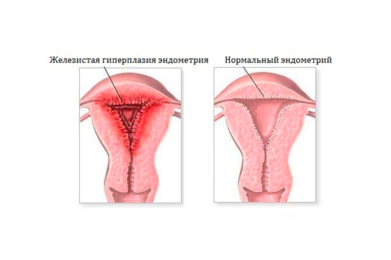 Очаговая железистая гиперплазия эндометрия. Железистая гиперплазия эндометрия. Железистая гиперплазия слизистой оболочки матки макро. Железистая гиперплазия эндометрия клиника. Гиперплазия эндометрия матки что это.