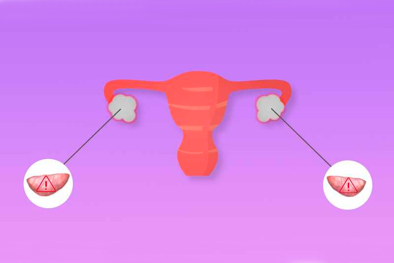 Синдром истощения яичников лечение беременность thumbnail