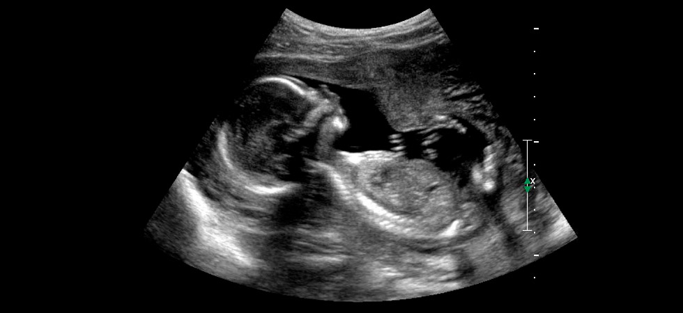 УЗИ на 18 неделе беременности - фото