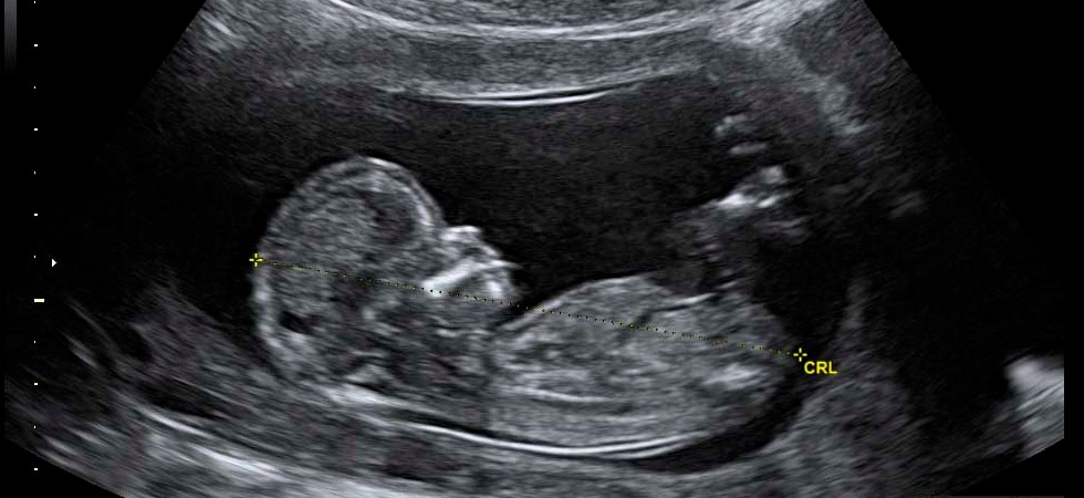 УЗИ на 15 неделе беременности - фото