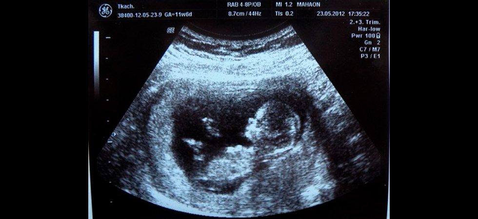 УЗИ на 11 неделе беременности - фото