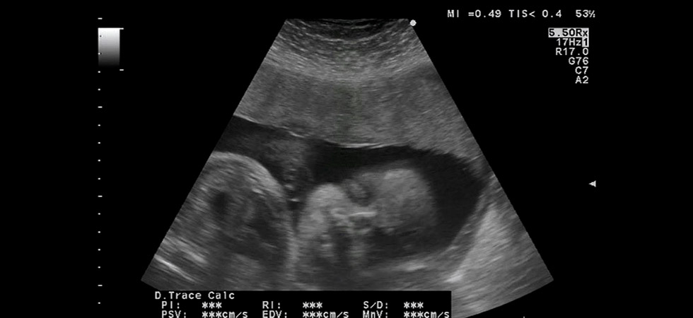 УЗИ на 38 неделе беременности - фото