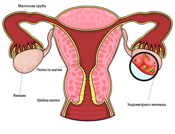 Эндометриоидная киста яичника