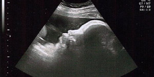 Тянет поясницу и живот 38 неделя беременности
