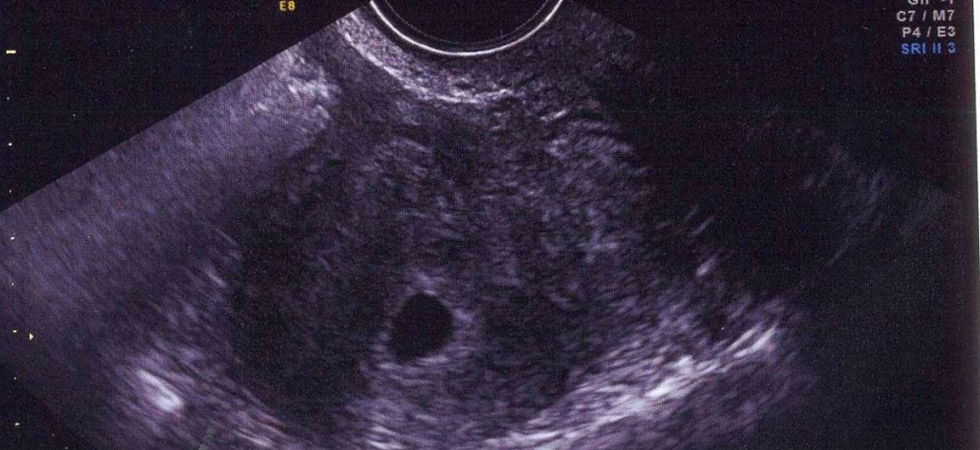 УЗИ на 3 неделе беременности - фото