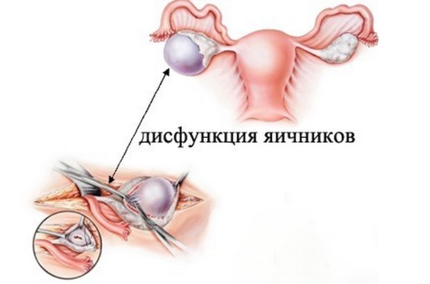 Как вылечить дисфункцией яичников thumbnail
