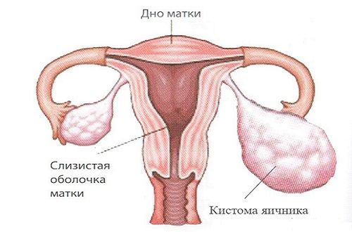 Кистома яичника