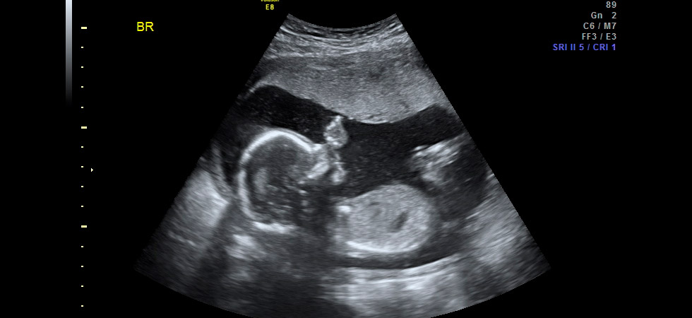 УЗИ на 26 неделе беременности - фото