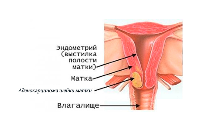 Аденокарцинома матки