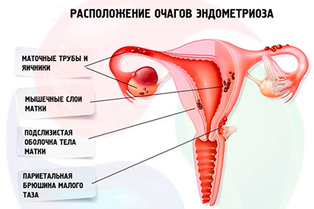 Генитальный эндометриоз