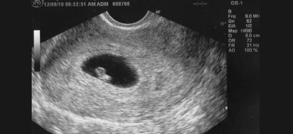 УЗИ на 6 неделе беременности - фото